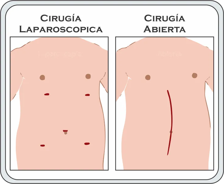 imagen Cirugia-Laparoscopica-vs-Cirugia-Abierta