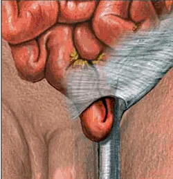 imagen hernia inguinal