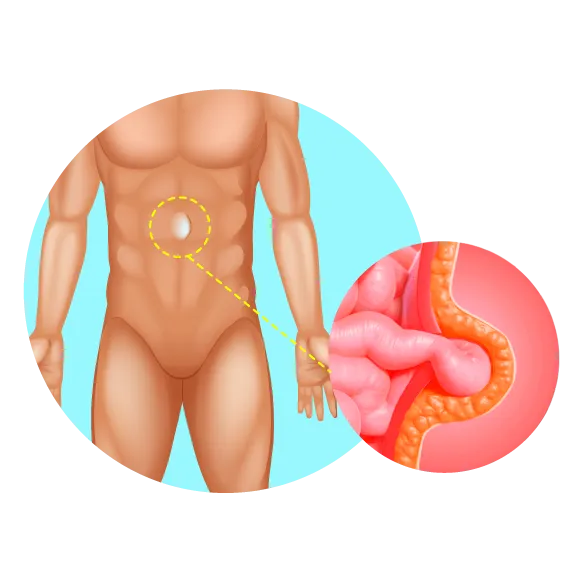 imagen hernia Epigástrica