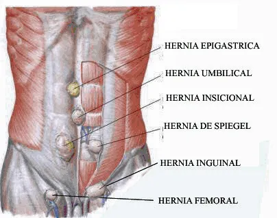 Tipos de Hernias, Hernias mas Frecuentes