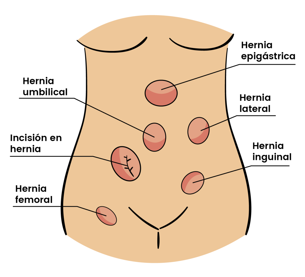 Tipos de Hernias