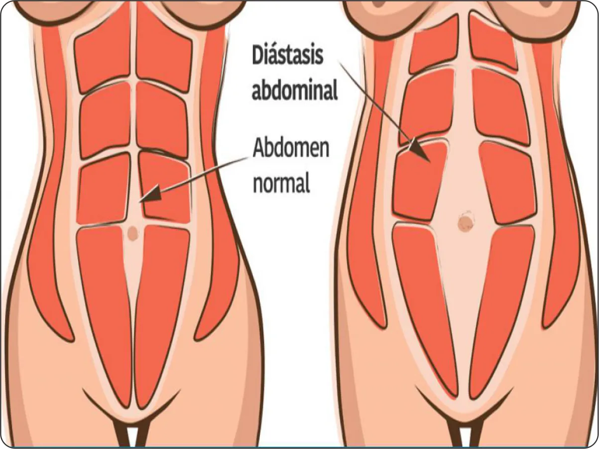 imagen hernia Epigástrica